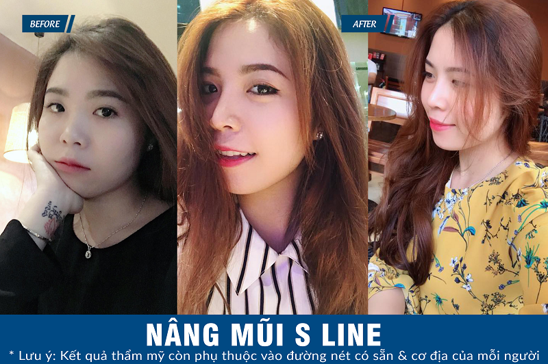 dáng mũi S line chuẩn Hàn
